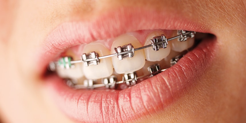 Studio Loro - dentista Biella - apparecchi ai denti