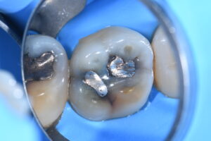Otturazione in amalgama | Studio Loro Dentista Biella