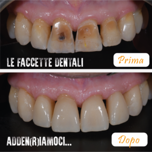 Studio Loro Dentista Biella estetica dentale faccette dentali prima e dopo