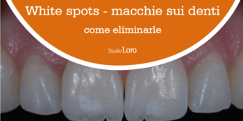 Studio Loro Dentista Biella come eliminare le white spots macchie sui denti
