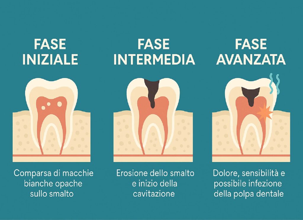 La carie nei bambini - le fasi della carie - studio loro dentista pediatrico a biella nuovo