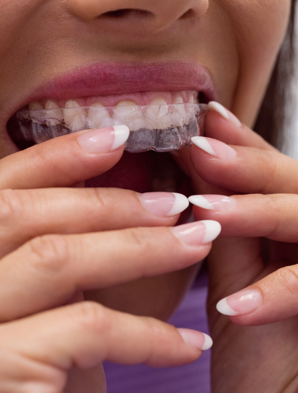 estetica dentale allineatori trasparenti biella studio loro